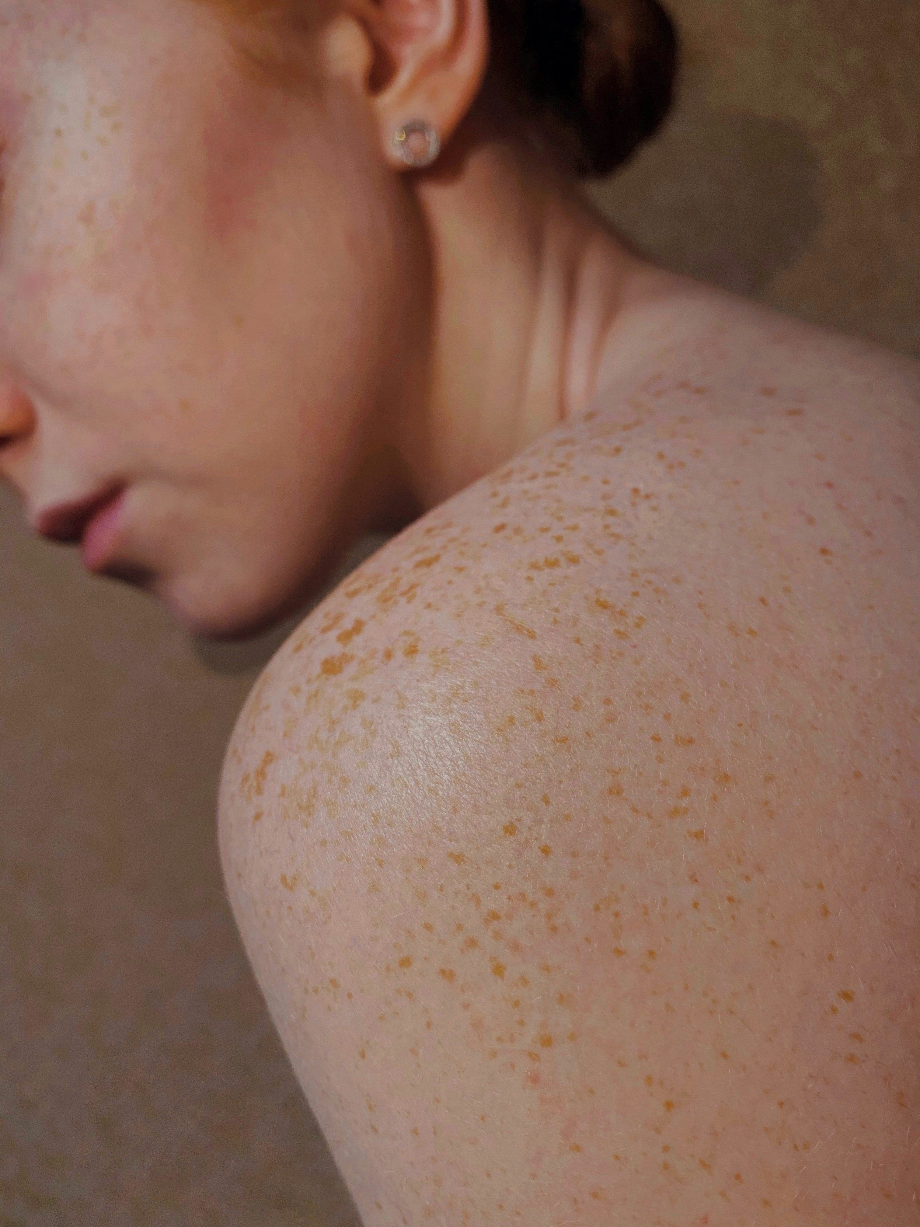 Psoriasis & Eczema Relief